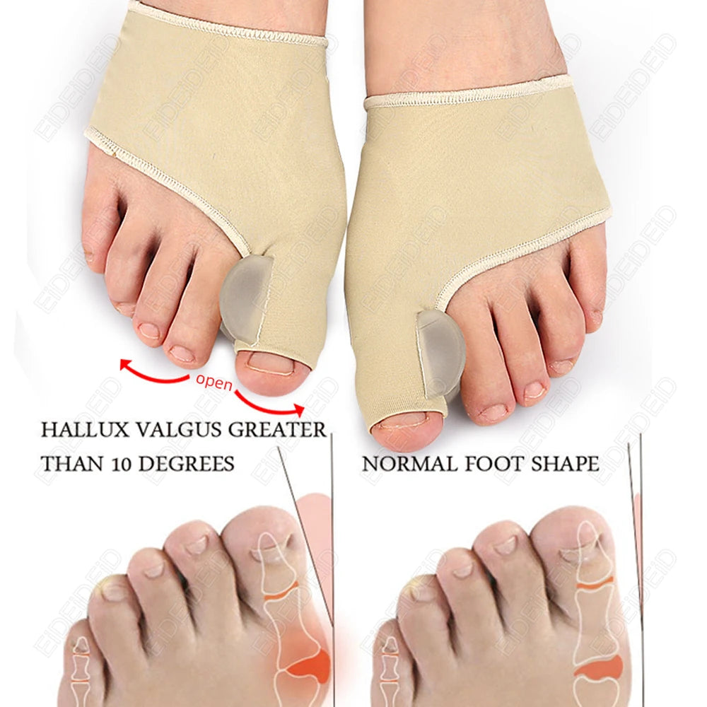 Bunion Corrector Silicone Gel | Hallux Valgus Toe Straightener & Pain Relief Sleeve - SBody Kings